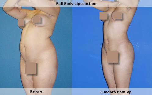 LVL, large volume liposuction